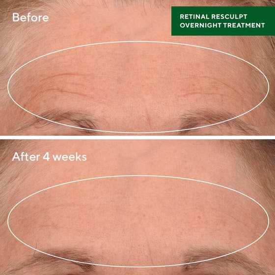 Retinal ReSculpt Treatment
