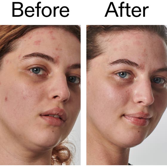 Urea 10% Moisturizer