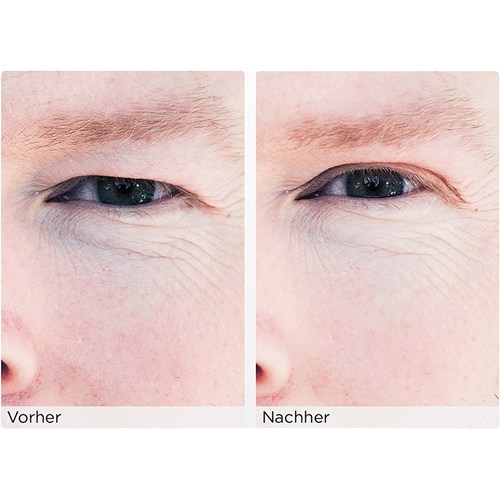 Wonderstripes The Instant Eye Lift Without Surgery