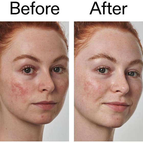 Azelaic Acid 10% Serum