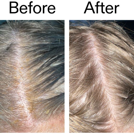 Salicylic Acid Exfoliating Scalp Treatment