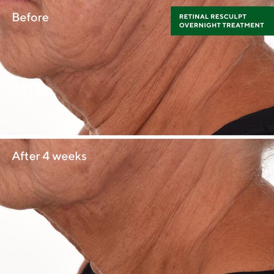 Retinal ReSculpt Treatment