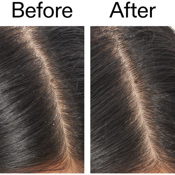 Salicylic Acid Exfoliating Scalp Treatment