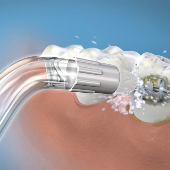 OD-100E Orthodontic Tip