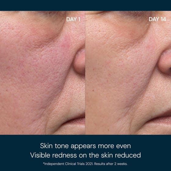 Dynamic Resurfacing Pads