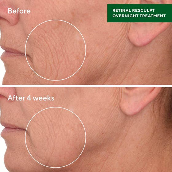 Retinal ReSculpt Treatment