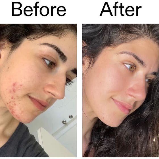 Succinic Acid Treatment