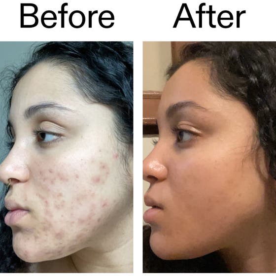 Tranexamic Acid Serum