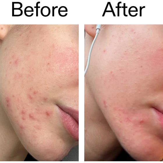 INKEY Blemish Clearing Moisturizer 2% Novoretin