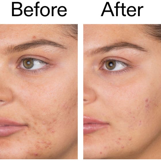 Salicylic Acid Cleanser